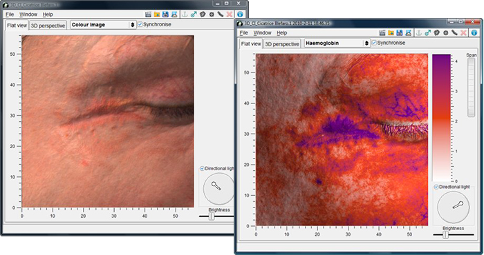 Antera 3D - analisi blefaroplastica