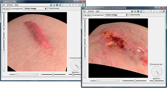 Antera 3D - analisi delle cicatrici