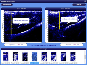 Modulo 2D del Software dell'Adipometro Bodymetrix  BX2000 : una visione ancora più ampia e
dettagliata degli spessori dei tessuti sottocutanei
Click per ingrandire