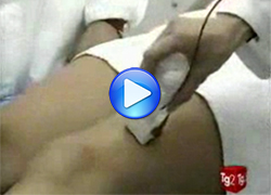 Idroelettroforesi e trattamento della cellulite con Hydrofor: video Rai2 - Medicina33, 21-11-2007
