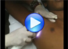 MeDioStar Next MED: epilazione su pelle scura - persona di colore